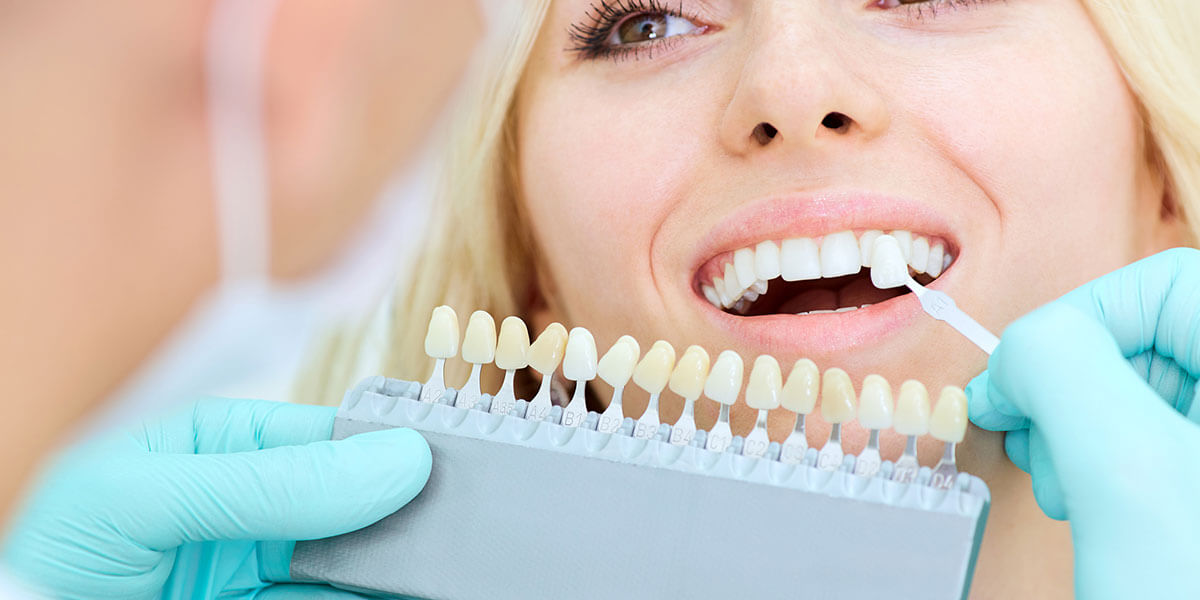 Dental Veneers