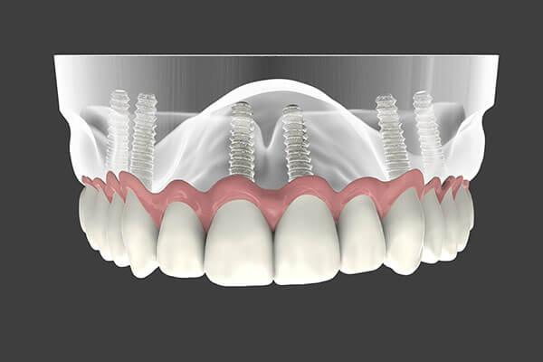 Implant Supported Dentures - Patient Smile